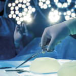 Linfoma anaplásico de células grandes asociado a implantes mamarios diagnosticado mediante punción por aguja fina. Caso clínico
