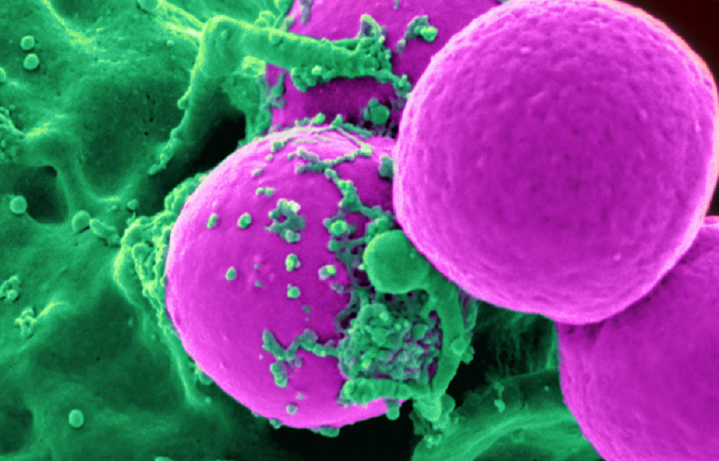 Detección del gen fusión PML-RAR? en pacientes colombianos con leucemia mieloide aguda
