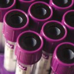 Hemoglobina Reticulocitaria en Screening de Ferropenia