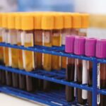 Estudio de inmunofenotipo por citometría de flujo para el diagnóstico de inmunodeficiencias primarias