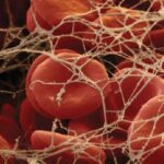 Utilización de los factores de riesgo y modelos clínicos predictivos para el diagnóstico de la enfermedad tromboembólica venosa