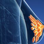Estudios de patología molecular utilizados para evaluar la amplificación del oncogén HER2 en cáncer de mama. Opinión Clínica