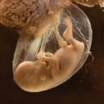 Células madre de cordón umbilical: usos clínicos y perspectivas