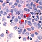 Caracterización de las Leucemias Agudas evaluadas mediante aspirado, biopsia y citometría de flujo en médula ósea durante los años 2012 – 2015, dinámica Ips. Medellín, Colombia