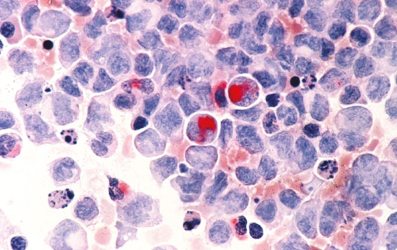 Caracterización de las Leucemias Agudas evaluadas mediante aspirado, biopsia y citometría de flujo en médula ósea durante los años 2012 – 2015, dinámica Ips. Medellín, Colombia