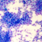 Testosterona y antígeno prostático específico en pacientes portadores de carcinoma prostático, provincia Holguín, 2013-2015