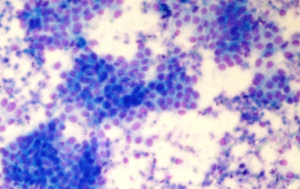 Testosterona y antígeno prostático específico en pacientes portadores de carcinoma prostático, provincia Holguín, 2013-2015