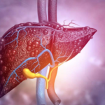Colestasis por deficiencia de 3?-?5-C27-hidroxiesteroide deshidrogenasa en un paciente con alteración en la síntesis de ácidos biliares. CASO CLÍNICO