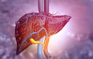 Colestasis por deficiencia de 3?-?5-C27-hidroxiesteroide deshidrogenasa en un paciente con alteración en la síntesis de ácidos biliares. CASO CLÍNICO