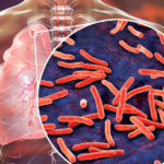 La COVID-19 pone de relieve la necesidad urgente de reactivar los esfuerzos mundiales por acabar con la tuberculosis