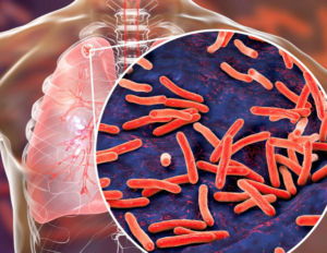 La COVID-19 pone de relieve la necesidad urgente de reactivar los esfuerzos mundiales por acabar con la tuberculosis