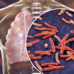 Predictores de tuberculosis pulmonar y experiencia con su diagnóstico molecular rápido