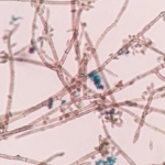 Diagnóstico microbiológico en un paciente con cromomicosis