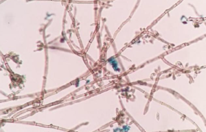 Diagnóstico microbiológico en un paciente con cromomicosis