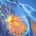 Cáncer de Mama Triple Negativo, otra enfermedad y nuevo reto