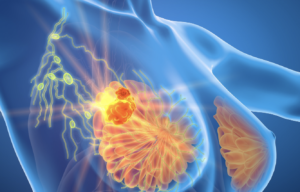 Cáncer de Mama Triple Negativo, otra enfermedad y nuevo reto