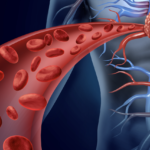 Biomarcadores cardiacos de aterotrombosis y su implicación en la estimación del riesgo de enfermedad cardiovascular