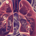 Tuberculosis Meníngea En Un Paciente Pediátrico: Reporte De Un Caso Clínico