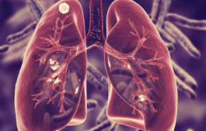Tuberculosis Meníngea En Un Paciente Pediátrico: Reporte De Un Caso Clínico
