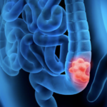 Asociación entre los niveles elevados de ácidos biliares y cáncer digestivo ARTÍCULO DE REVISIÓN