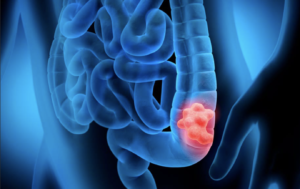Asociación entre los niveles elevados de ácidos biliares y cáncer digestivo ARTÍCULO DE REVISIÓN