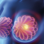 Carcinoma bilateral de mama en crisis visceral