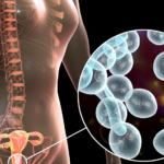 Infecciones cervicovaginales en exudados vaginales