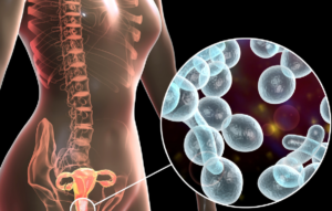 Infecciones cervicovaginales en exudados vaginales