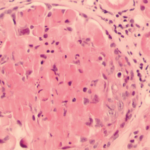 Granulomatosis con poliangeítis: actualización y conceptos claves
