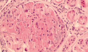 Granulomatosis con poliangeítis: actualización y conceptos claves