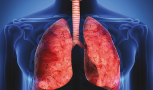 Tuberculosis pleural en un hospital del Noreste Argentino