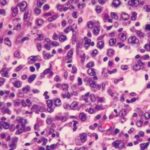 Estudio Descriptivo: Características Clínicas, Demográficas e Histopatológicas de Pacientes con Diagnóstico de Linfoma no Hodgkin