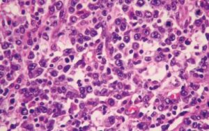 Estudio Descriptivo: Características Clínicas, Demográficas e Histopatológicas de Pacientes con Diagnóstico de Linfoma no Hodgkin