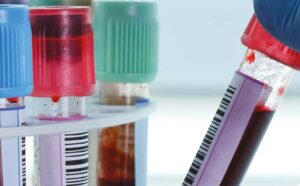 La medición de lípidos en estado postprandial representa mejor nuestros hábitos