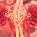 Utilidad de los parámetros urinarios en la enfermedad renal crónica avanzada
