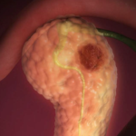 Pancreatitis Aguda: Evidencia Actual