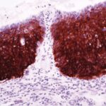 Heat Shock Protein 27 (G3.1) - Stathmin (SP49) Dos nuevos biomarcadores para la identificación de Neoplasia Intraepitelial Cervical (CIN) y Carcinoma Cervical Escamoso (CSC)