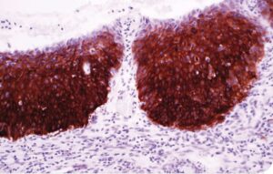 Heat Shock Protein 27 (G3.1) - Stathmin (SP49) Dos nuevos biomarcadores para la identificación de Neoplasia Intraepitelial Cervical (CIN) y Carcinoma Cervical Escamoso (CSC)