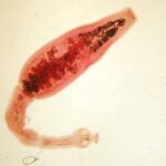 Diagnóstico, tratamiento y seguimiento de la hidatidosis