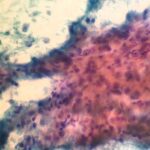 Daño hepatocelular, proteinuria y autoinmunidad: ¿enfermedad multisistémica o coincidencia de enfermedades?