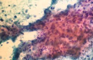 Daño hepatocelular, proteinuria y autoinmunidad: ¿enfermedad multisistémica o coincidencia de enfermedades?