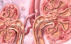 Proteinuria en gammapatías monoclonales