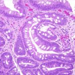 Carcinoma neuroendocrino de esófago: reporte de caso
