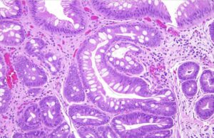 Carcinoma neuroendocrino de esófago: reporte de caso