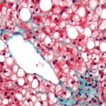 Daño hepatocelular, proteinuria y autoinmunidad: ¿enfermedad multisistémica o coincidencia de enfermedades? CASO CLÍNICO