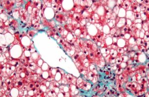 Daño hepatocelular, proteinuria y autoinmunidad: ¿enfermedad multisistémica o coincidencia de enfermedades? CASO CLÍNICO