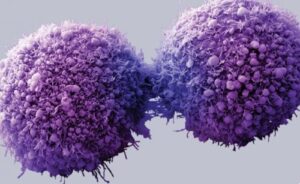 Rendimiento diagnóstico del marcador tumoral CA 19-9 en la diferenciación entre patología bilio-pancreática benigna y maligna