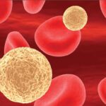 Neutropenia inducida por quimioterapia en pacientes con cáncer de mama