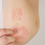 HLA Cw6 como herramienta para el diagnóstico de la Psoriasis