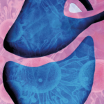 Pericarditis purulenta por Mycobacterium tuberculosis y Streptococcus pneumoniae. Revisión del tema, a propósito de un caso